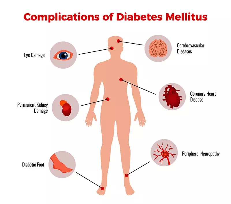 間充質(zhì)干細胞在治療糖尿病及并發(fā)癥的臨床應用潛力