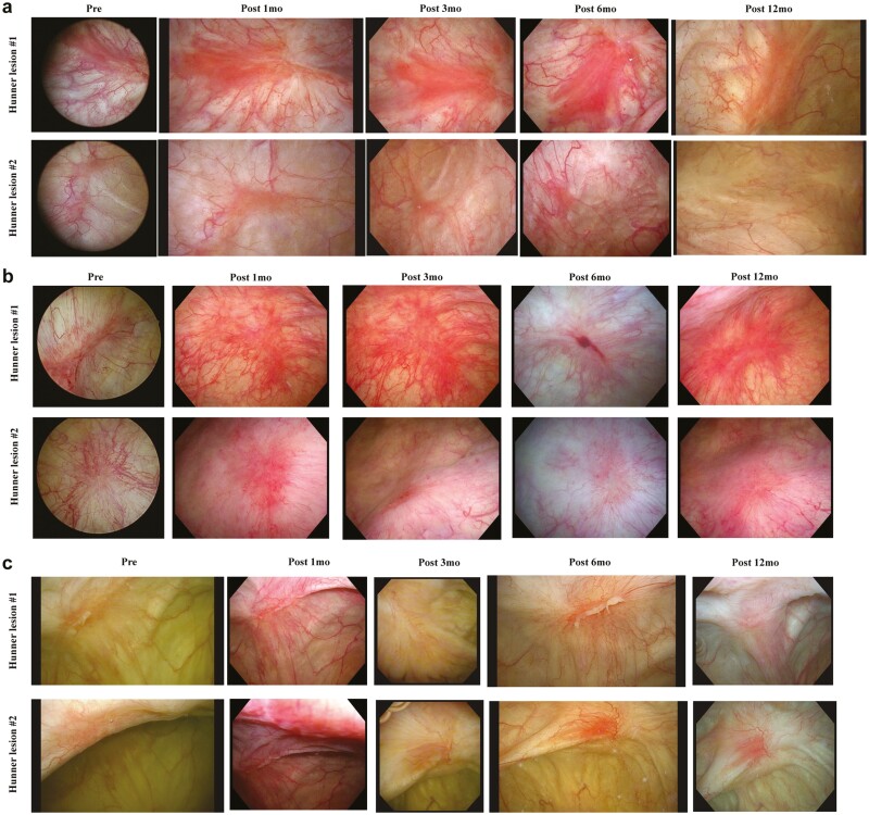 圖1：每位患者Hunner病變的連續膀胱鏡圖像。