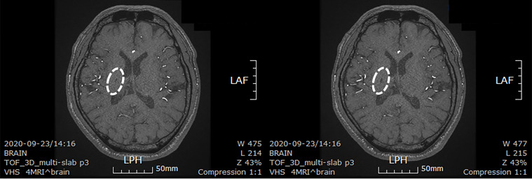 圖4：微創(chuàng  )人臍帶間充質(zhì)干細胞移植后患者的腦部計算機斷層掃描圖像。
