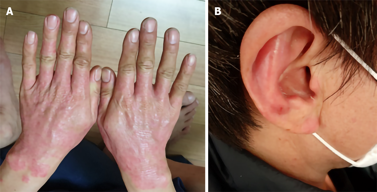 圖1：銀屑病治療前皮損部位。