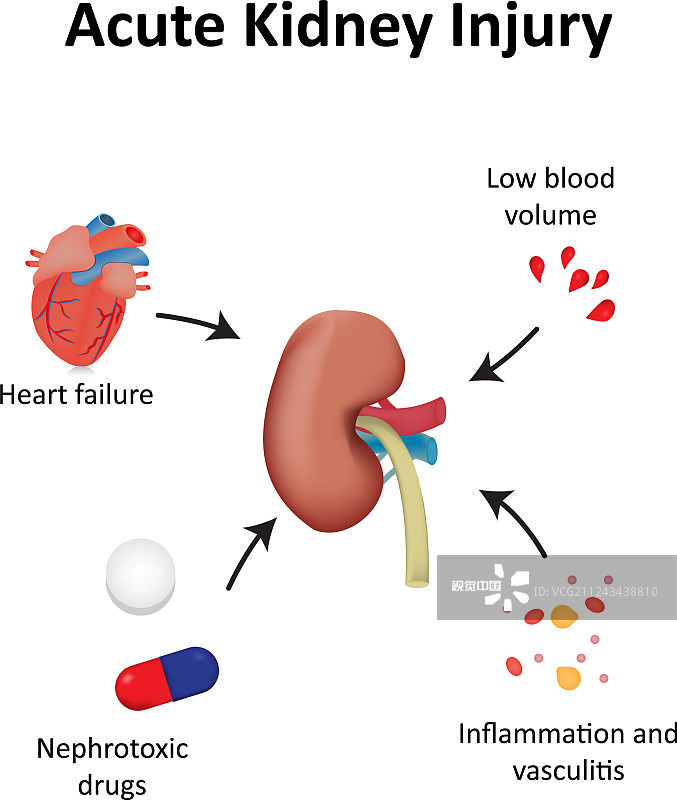 間充質(zhì)干細胞治療急性腎損傷的臨床研究進(jìn)展 間充質(zhì)干細胞治療急性腎損傷的臨床研究進(jìn)展