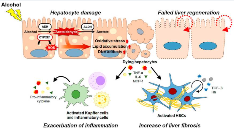 酒精及其代謝物通過(guò)各種途徑和/或機制共同促進(jìn)ALD的發(fā)病機制。（如圖1）