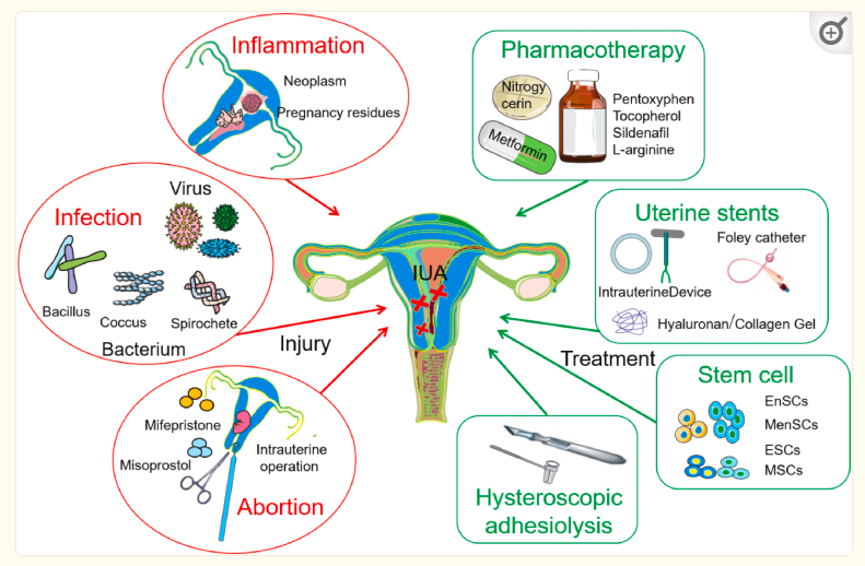 圖1：子宮內膜損傷的機制及主要治療策略。