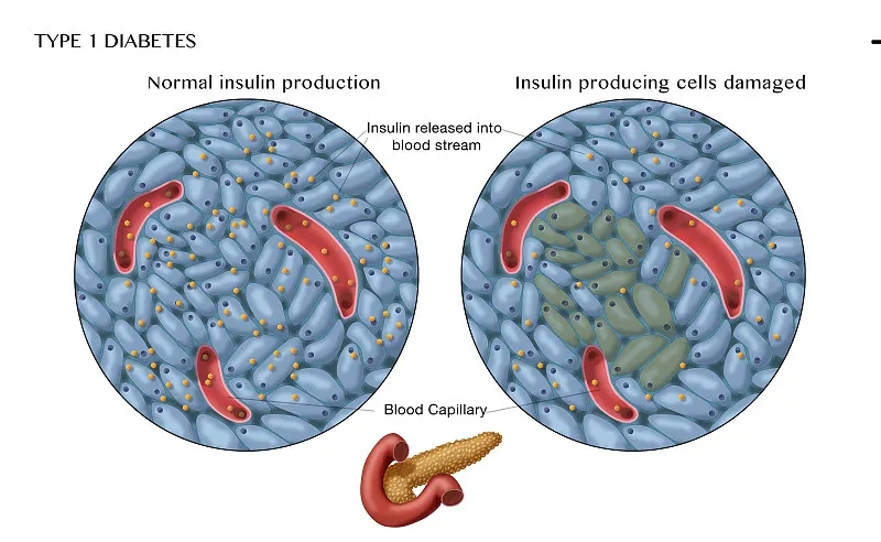 間充質(zhì)干細胞在1型糖尿病治療中的作用