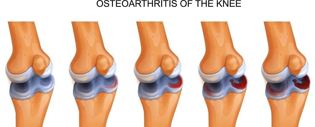 國內外臨床研究表明：干細胞修復半月板損傷更具優(yōu)勢