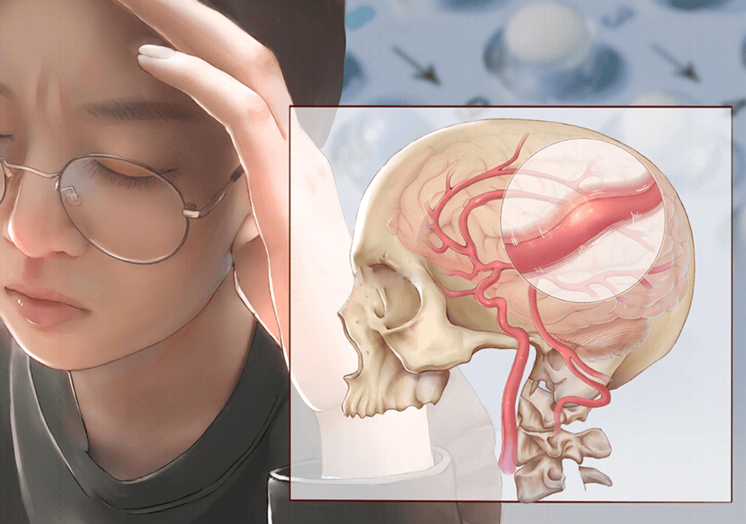 什么是偏頭痛？