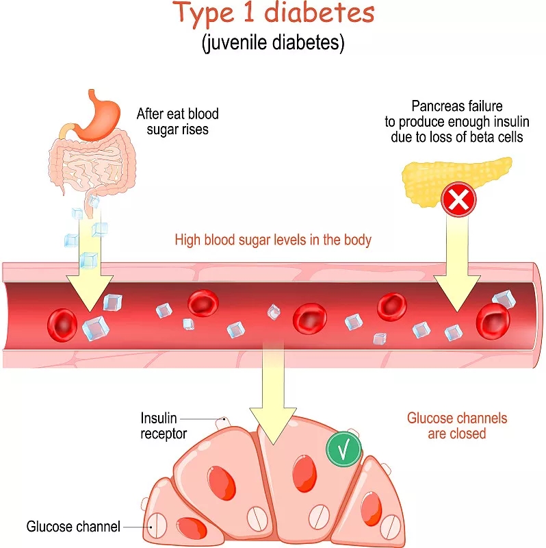 1型糖尿病癥狀有哪些？