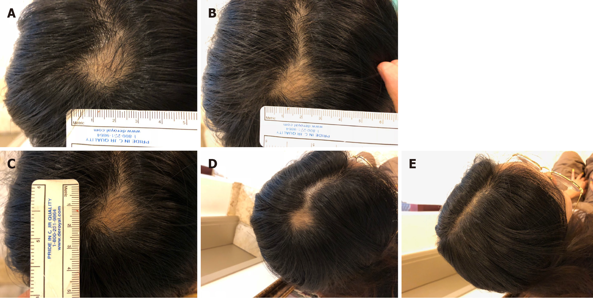 圖4：病例2治療期間和治療后病變部位可見(jiàn)變化。 
