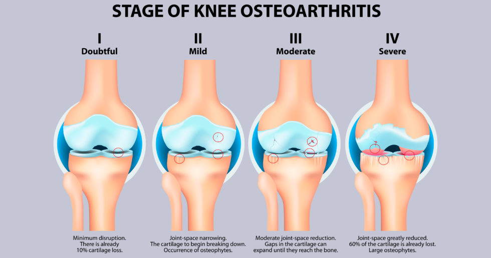 骨關(guān)節炎癥狀有哪些