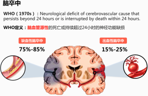 干細胞治療缺血性腦卒中的效果跟給藥途徑有關(guān)嗎