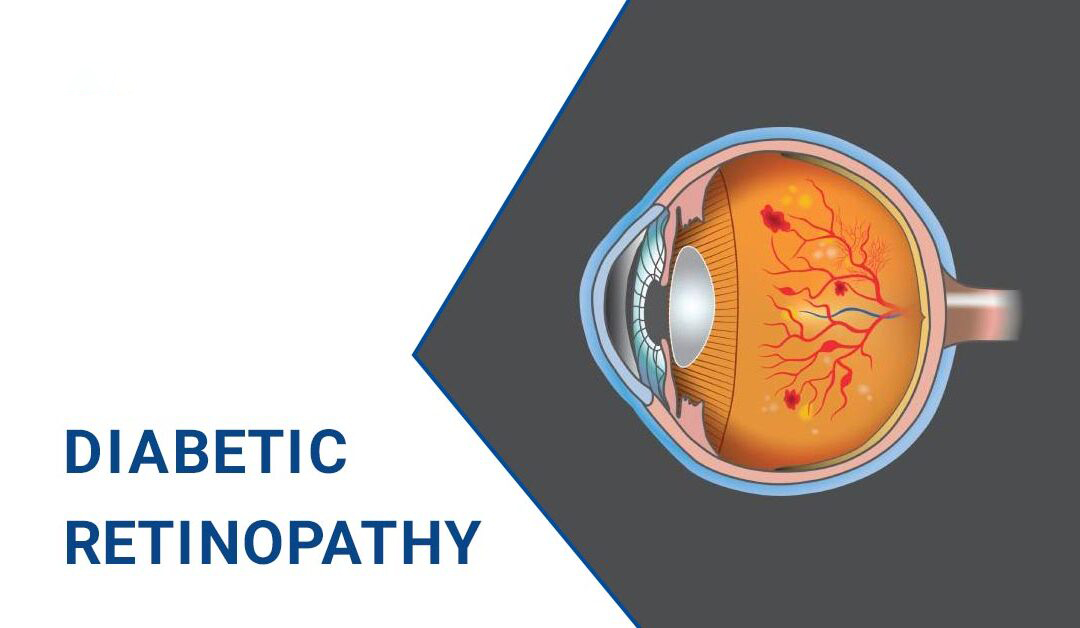 糖尿病視網(wǎng)膜病變–原因、階段和治療