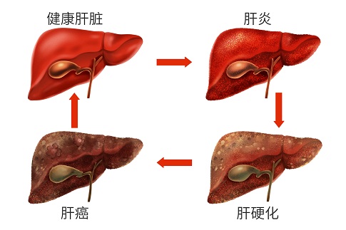 人臍帶血間充質(zhì)干細胞移植治療失代償性肝硬化患者