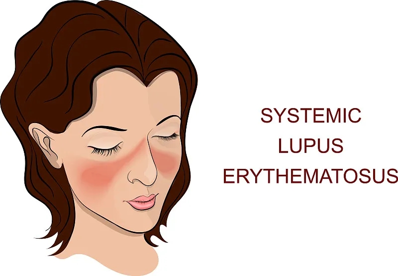 系統性紅斑狼瘡是一種自身免疫性疾病，其特征在于針對細胞核和細胞質(zhì)抗原的自身抗體