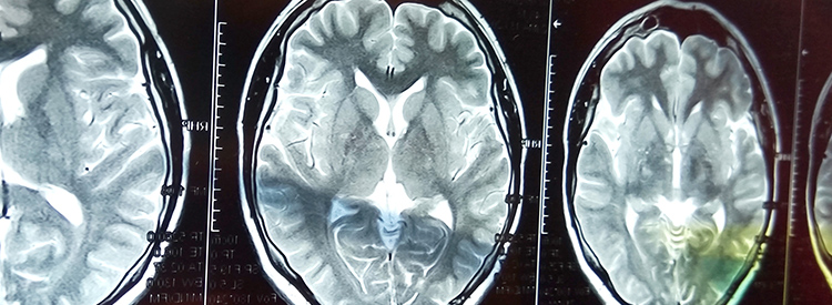 中風(fēng)患者的干細胞治療 中風(fēng)患者的干細胞治療