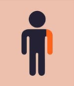 單癱型腦癱影響一側肢體，通常是手臂。