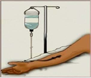 靜脈注射圖像。