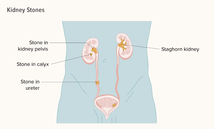 關(guān)于腎結石您需要知道的一切