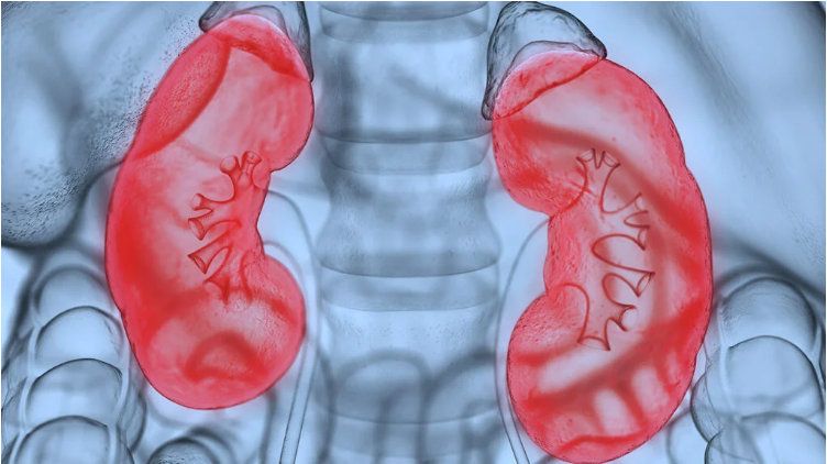 什么是腎病綜合征？癥狀和治療
