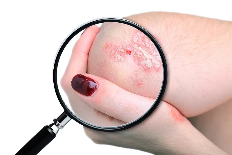 國內已有7項臨床研究項目，干細胞治療銀屑病，未來(lái)可期！