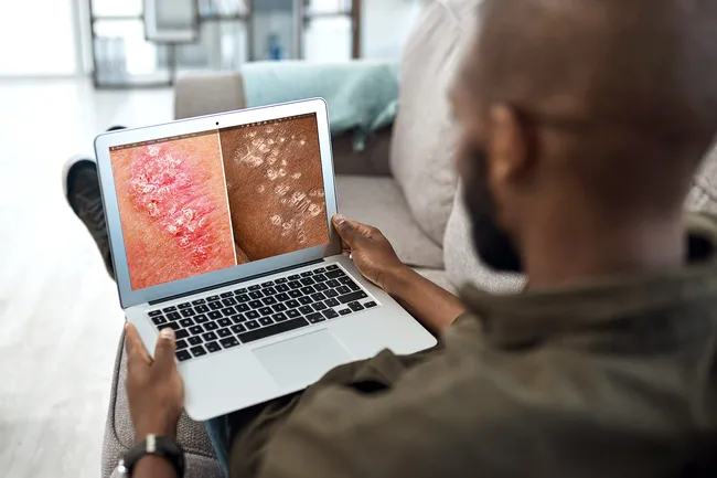 銀屑病的癥狀、類(lèi)型和原因