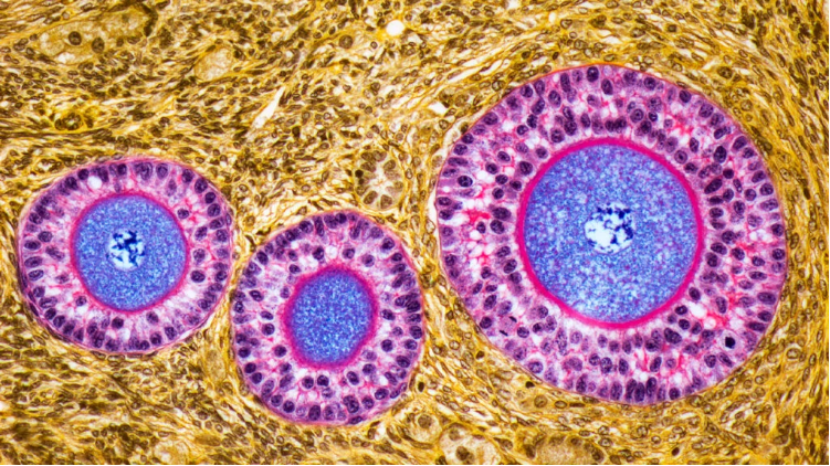 卵巢早衰體征和癥狀是什么？及其治療方法