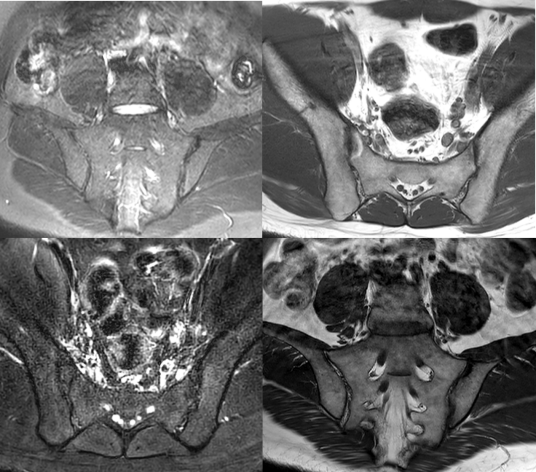 強直性脊柱炎是遺傳病嗎？
