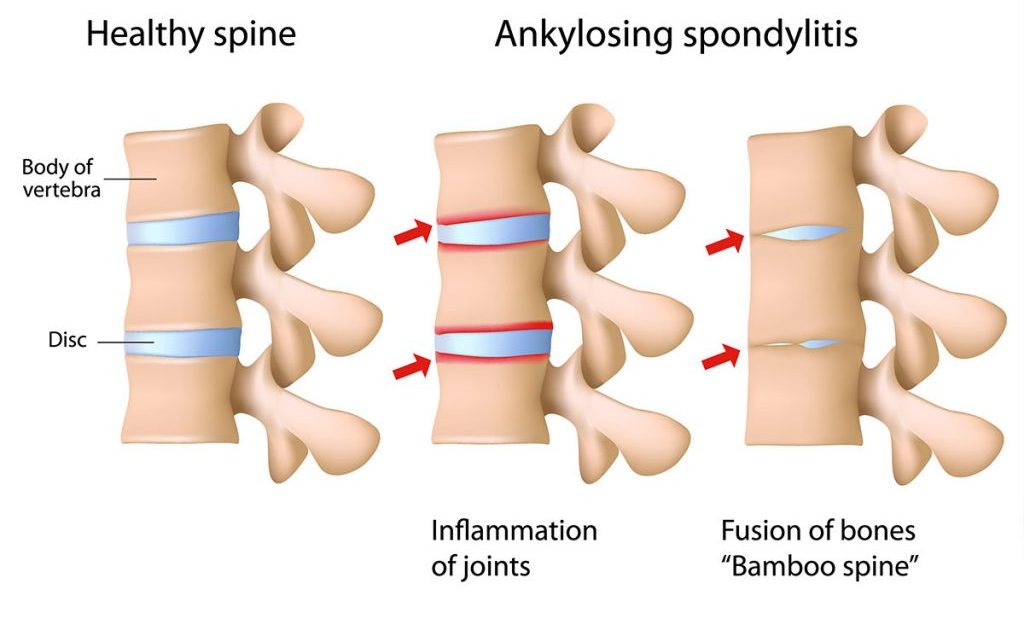 間充質(zhì)干細胞療法與強直性脊柱炎:一種新的治療方法 間充質(zhì)干細胞療法與強直性脊柱炎:一種新的治療方法