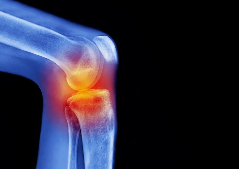 骨關(guān)節炎——間充質(zhì)干細胞在軟骨再生中的作用