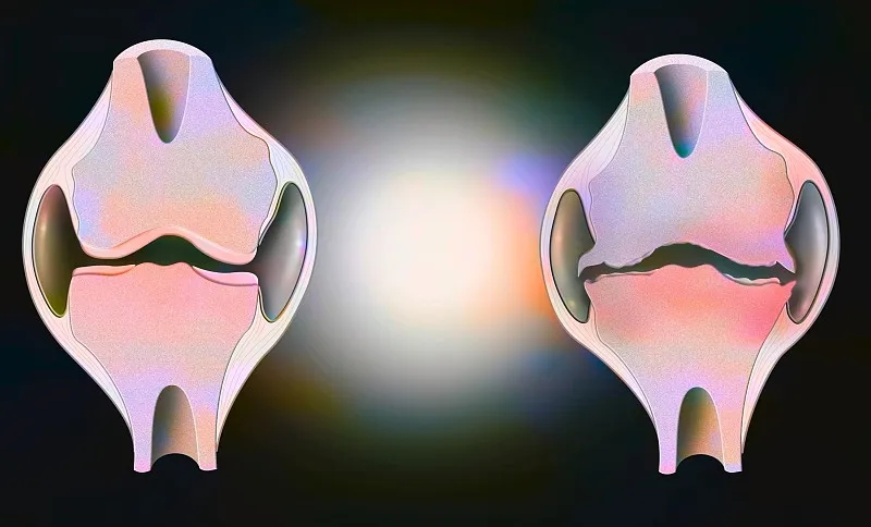 盤(pán)點(diǎn):2020~2023年干細胞治療骨關(guān)節炎的臨床研究進(jìn)展 盤(pán)點(diǎn):2020~2023年干細胞治療骨關(guān)節炎的臨床研究進(jìn)展