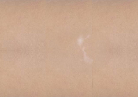 白癜風(fēng)白斑初期癥狀輕微小斑點(diǎn)，無(wú)色素。