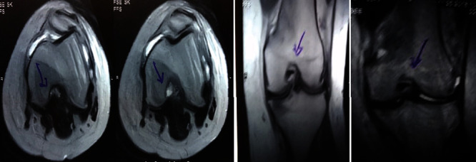 圖1：治療前MRI顯示內側和外側半月板后角的III級撕裂。