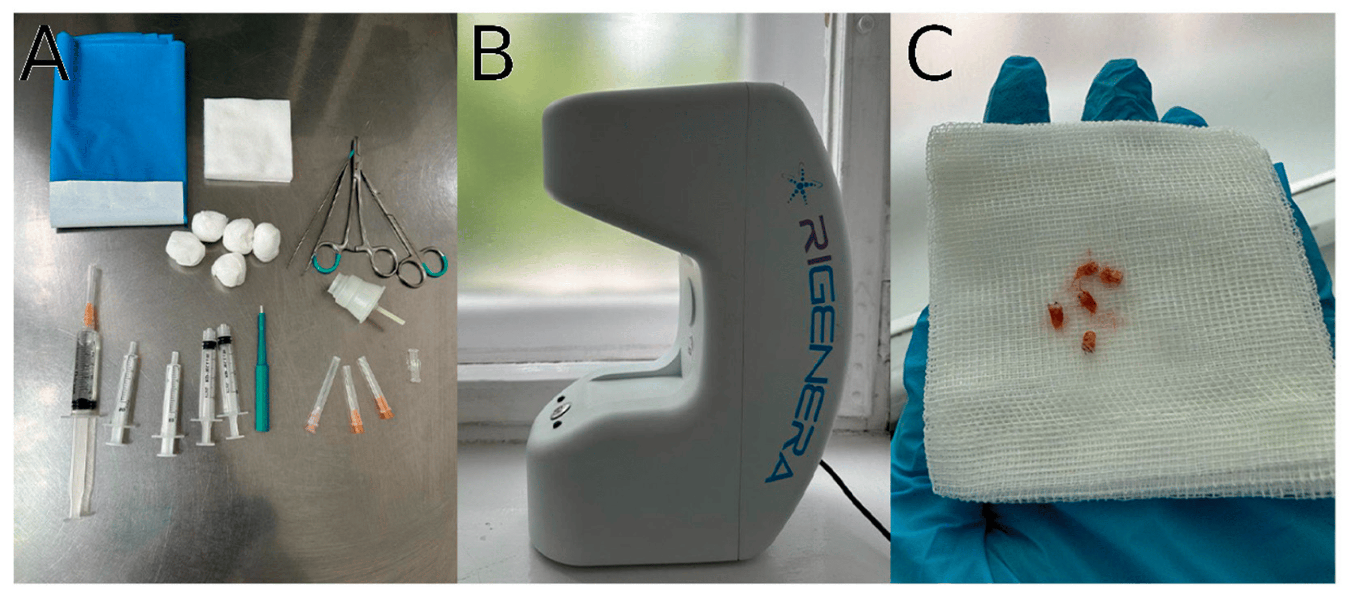 圖1：自體細胞微移植治療方案要素。