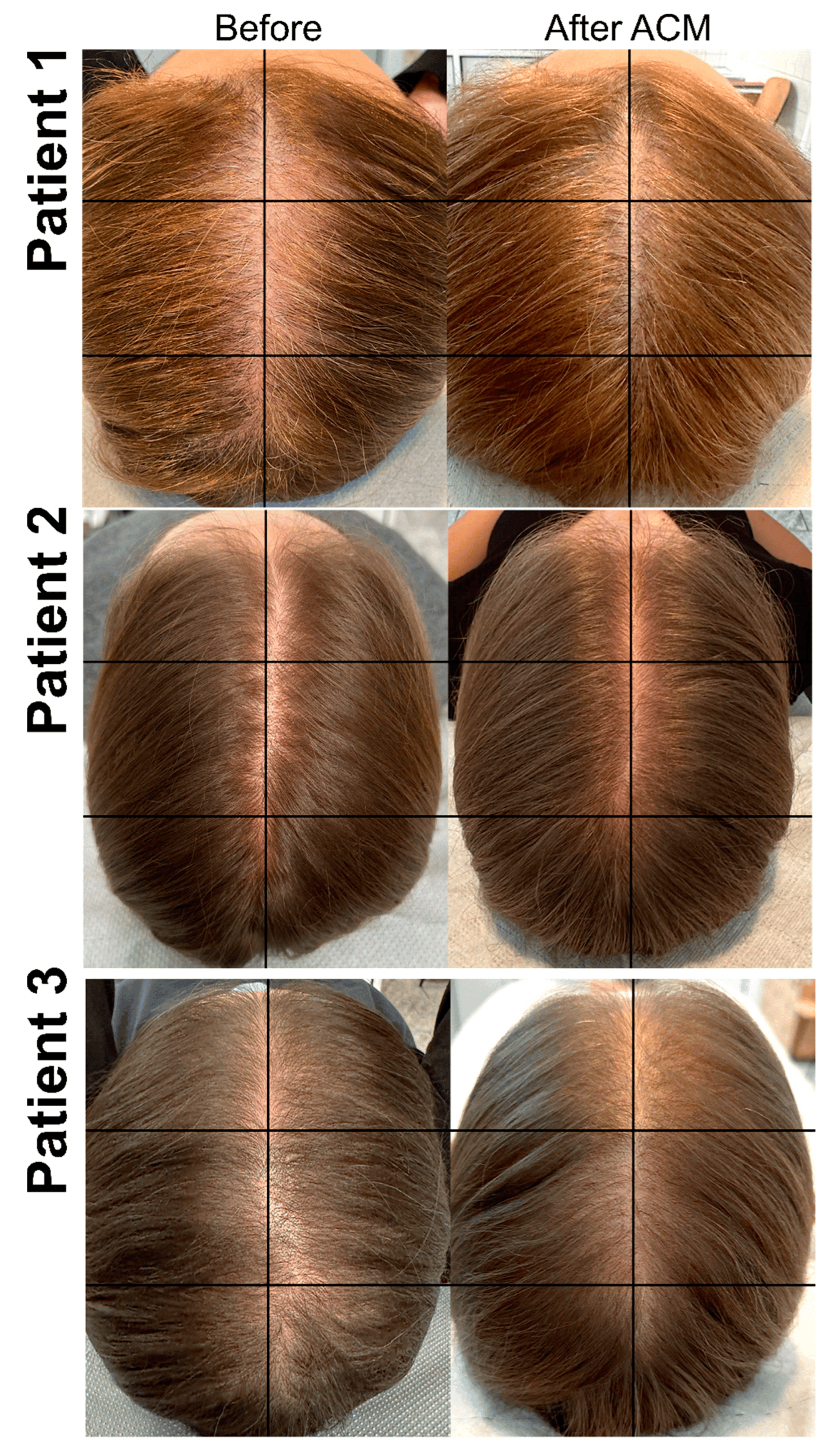 圖2：ACM治療前和治療后AGA患者樣本的照片。
