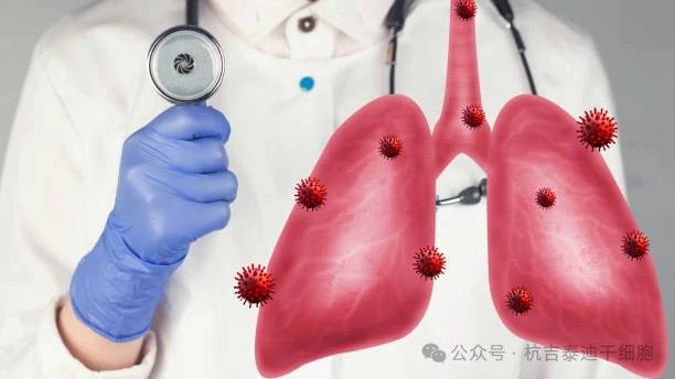 干細胞療法如何減緩肺部疾病的癥狀？