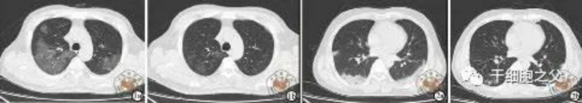 細胞輸注后，炎癥指標改善，復查胸部CT提示雙肺病灶較前吸收，呼吸道癥狀改善，新型冠狀病毒核酸檢測連續2次陰性，治愈出院。