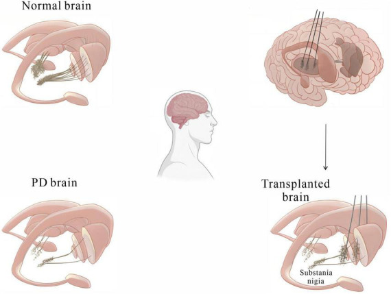 圖2：基本圖顯示細胞移植療法如何緩解帕金森病患者的運動(dòng)癥狀。