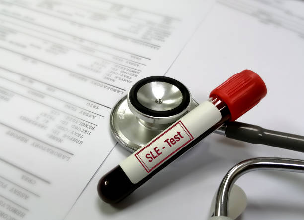 臍帶干細胞可以幫助狼瘡患者嗎？