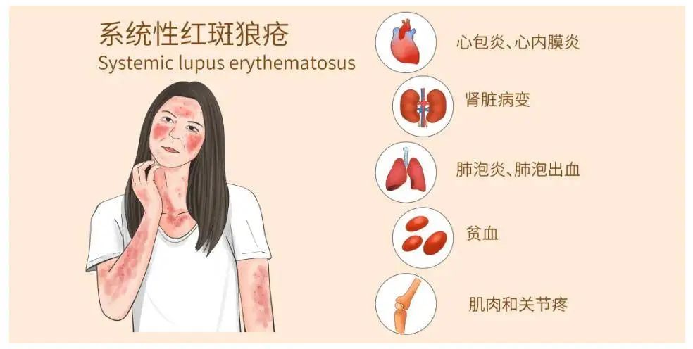 什么是系統性紅斑狼瘡？