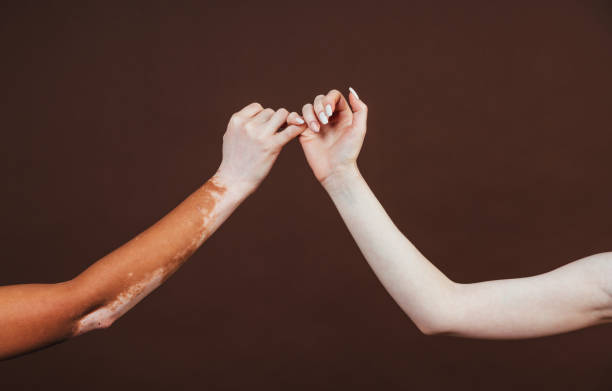 干細胞轉換醫學(xué)雜志：干細胞治療難治性白癜風(fēng)安全有效