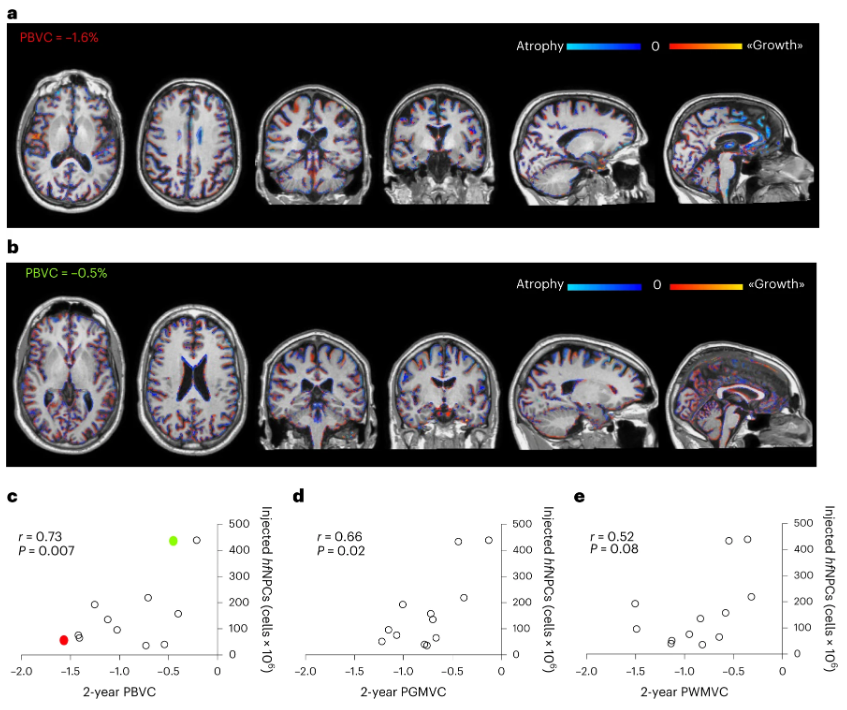 較低的腦萎縮與大量注射干細胞相關(guān)