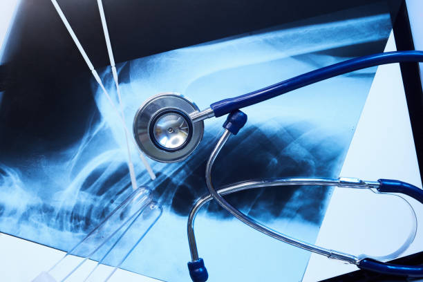 干細胞治療在風(fēng)濕病中的作用