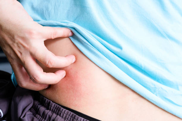 肝硬化肝腎綜合征的診斷、預防和治療