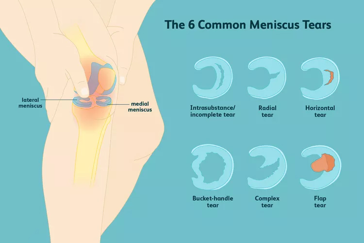 膝關(guān)節半月板損傷：你了解這六種撕裂類(lèi)型嗎？