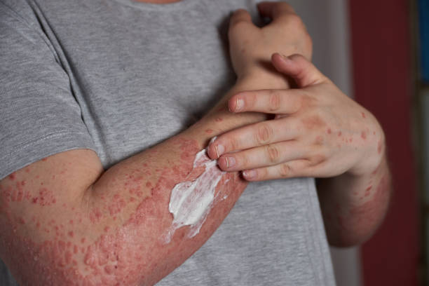 銀屑病的4類(lèi)治療方式和用藥類(lèi)型，你都清楚嗎？