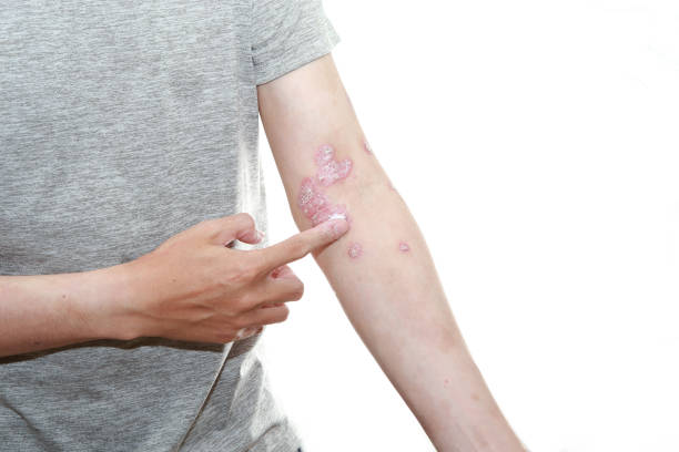 預防銀屑病發(fā)作的10個(gè)技巧，你都了解嗎？