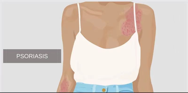 銀屑病的體征和癥狀是什么？及其治療方法