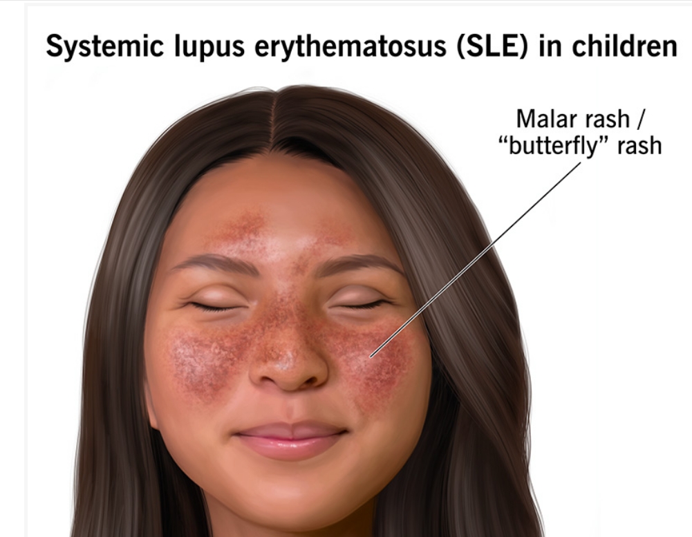 什么是兒童系統性紅斑狼瘡？及其病因和治療方法