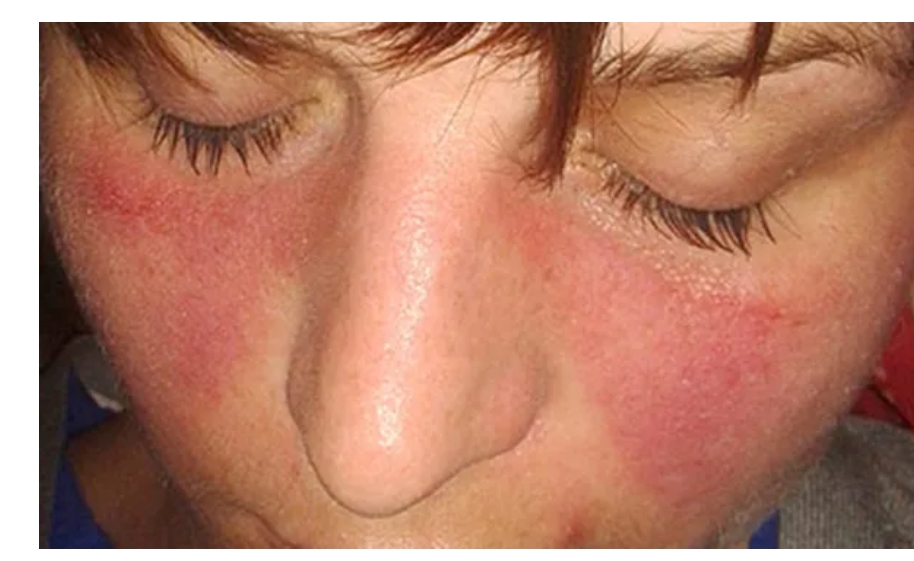 系統性紅斑狼瘡癥狀、病因和治療方法