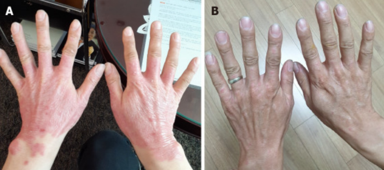 3次干細胞治療后25年?銀屑病頑疾得到顯著(zhù)改善！