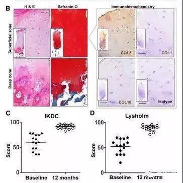 干細胞治療膝骨關(guān)節炎臨床案例